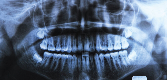 Conoce 1 aplicación de las radiografías dentales en Silao para tu salud